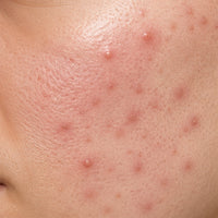 Acne & Blemishes