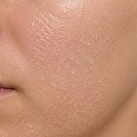 Dryness & Dehydration